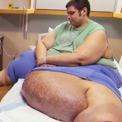Quilos Mortais: como está J.T., que pesava 404 kg e tinha linfedema grave