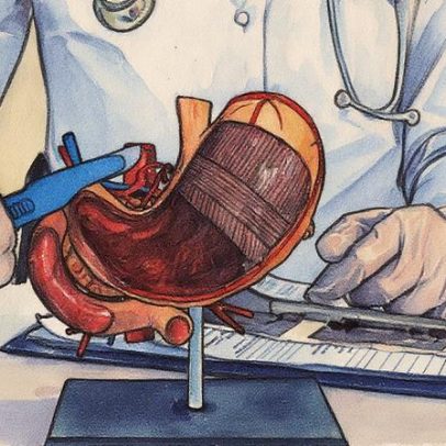 Novas diretrizes para cirurgia bariátrica visam melhorar a segurança dos pacientes