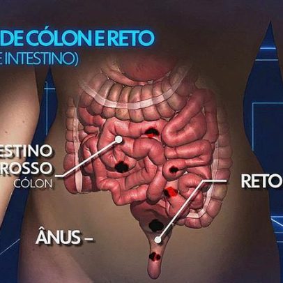 Mudanças simples no dia a dia podem cortar em até 30% o risco de câncer intestinal