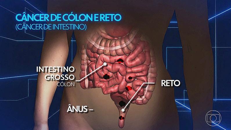 Médicos alertam sobre o aumento do câncer colorretal em pessoas com menos de 50 anos (Foto: Reprodução)