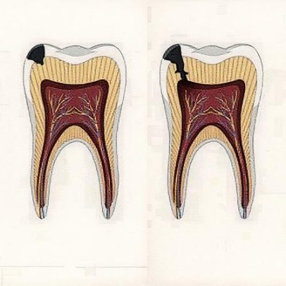 Exercício físico e ômega-3 diminuem gravidade de infecções dentárias