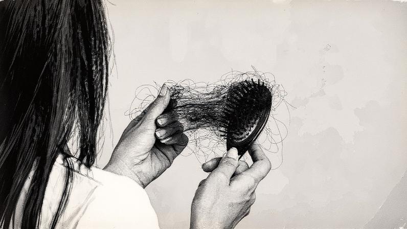 Alopecia areata afeta a saúde mental e a qualidade de vida, além da perda capilar (Foto: Reprodução)