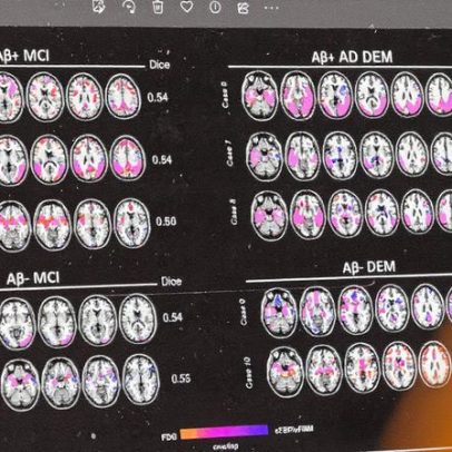 Novo medicamento para Alzheimer é lançado no Brasil e promete avanços no tratamento