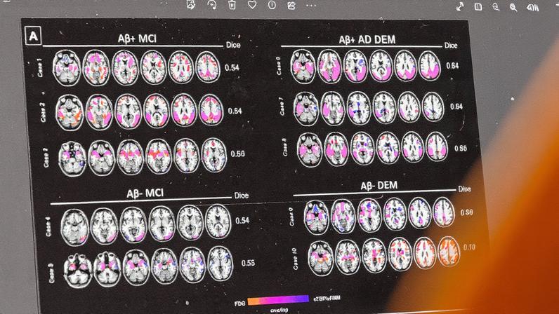 Kisunla é apresentado como o primeiro medicamento no Brasil para retardar o Alzheimer inicial (Foto: Reprodução)