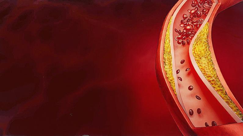 Placas de gordura dificultam a circulação nas artérias, caracterizando a aterosclerose (Foto: Reprodução)