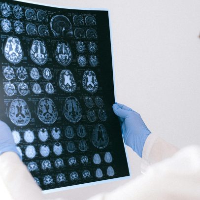 Quatro caminhos que levam ao Alzheimer de acordo com pesquisa