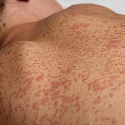 Casos de sarampo caem 71% em 24 anos com melhora da cobertura vacinal