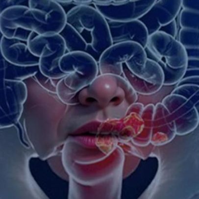 Pacientes com câncer colorretal são diagnosticados em estágio avançado