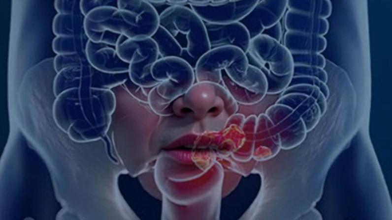 Pacientes com câncer colorretal são diagnosticados em estágio avançado