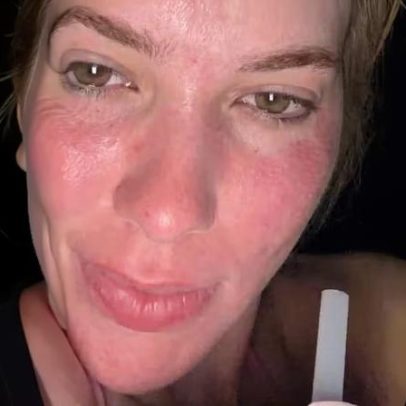 Após vermelhidão Virginia Fonseca afirma que glow up do laser já apareceu