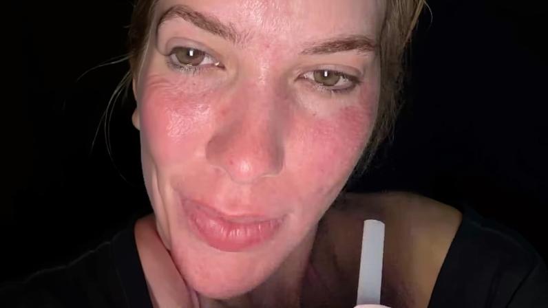 Após enfrentar vermelhidão intensa, Virginia Fonseca afirma que ‘glow up’ do laser já apareceu; veja evolução — Foto: Reprodução/Instagram