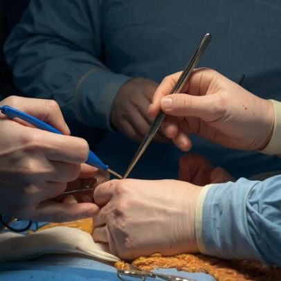 Técnica brasileira sem robôs reduz custos em cirurgia de próstata pelo SUS