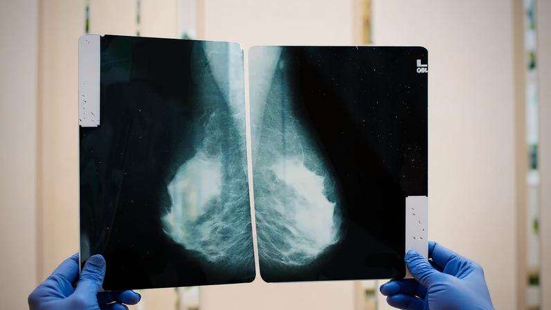 The research found women told about their breast density were more likely to seek advice from their GP and were also more likely to feel anxious. Photograph: Marina Krasnokutska/Alamy