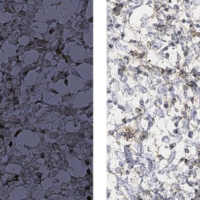 Pesquisadores do MIT identificam novos alvos imunoterapêuticos para glioblastoma
