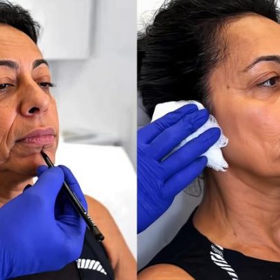 Vídeo de transformação de Samantha Schmütz com médico das Kardashians viraliza