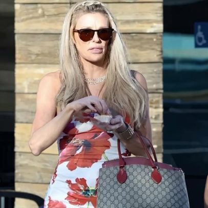 Brandi Glanville recebe diagnóstico sobre deformidade facial