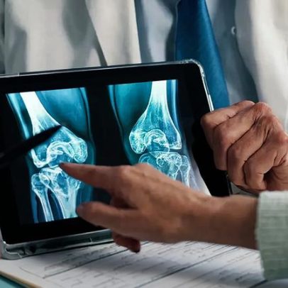 Casos de osteoporose devem crescer no Brasil até 2050