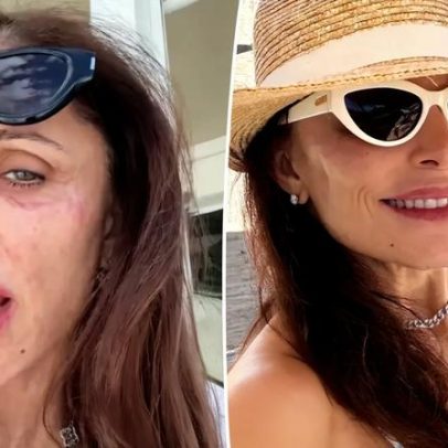 Bethenny Frankel contrai infecção no rosto após festa em St. Barts no Ano Novo