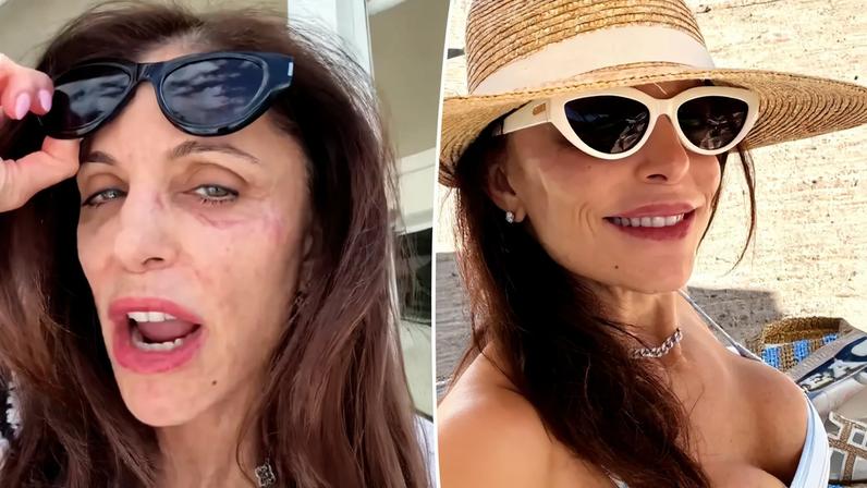 Bethenny Frankel contracted a bacterial infection on her face after partying in St. Barts for New Year’s Eve.