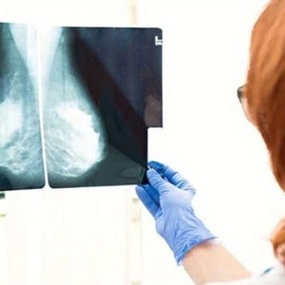 Teste sanguíneo pode indicar qual tratamento de câncer de mama funciona melhor
