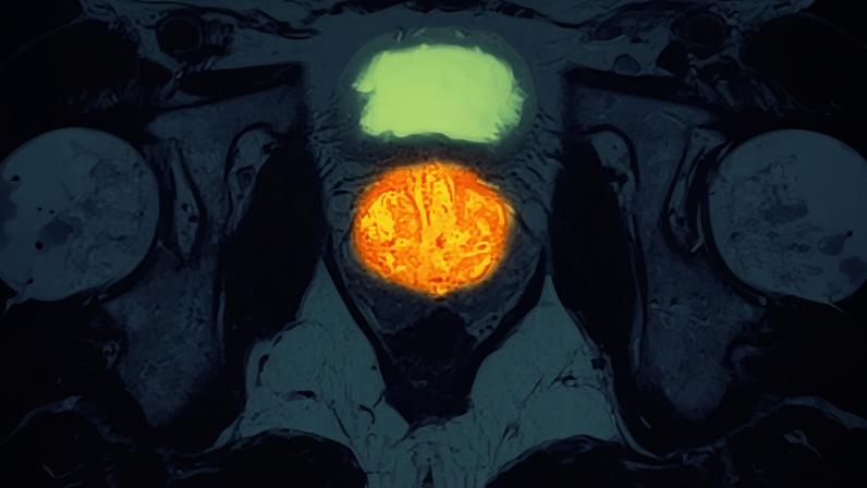 An MRI scan of the pelvis showing prostate cancer. About 55,300 people are diagnosed with the disease in the UK each year.