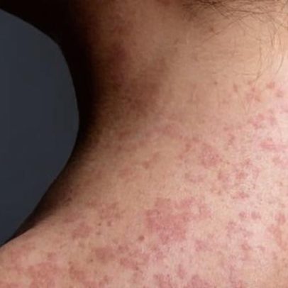 Aumento de sarampo em feriados gera alertas de saúde em NSW, SA e Victoria