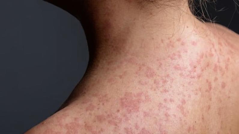 Measles is highly airborne and can linger in a room for up to 30 minutes after an infectious person has left.