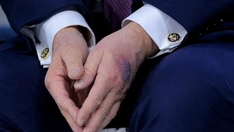 A bruise is seen on the back of U.S. President Donald Trump's hand during a signing ceremony for his “Board of Peace” at the World Economic Forum in Davos, Switzerland, on Jan. 22.