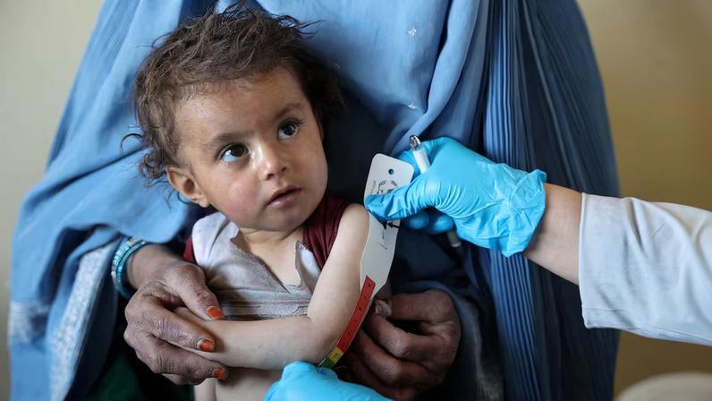 An Afghan girl looks at the doctor as he measures her upper arm at the WFP-supported Qasaba Clinic, after an increase in malnutrition cases following the return of deported Afghans, in Kabul, Afghanistan, January 7, 2026. REUTERS/Sayed Hassib TPX IMAGES OF THE DAY