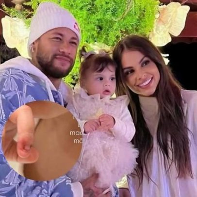 Dedo da filha de Neymar após fratura exposta em acidente doméstico