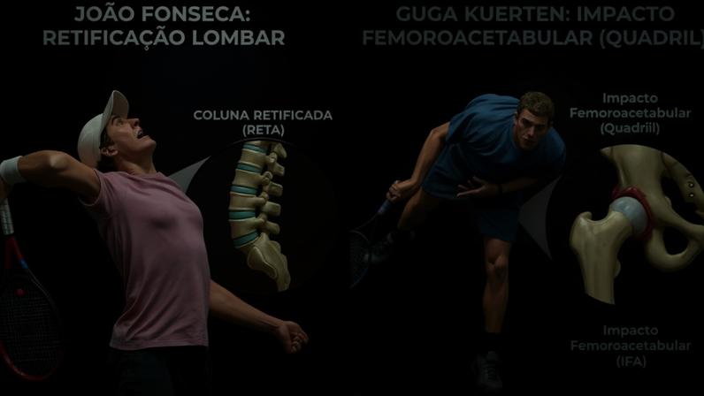 Arte compara as lesões de João Fonseca com a de Guga Kuerten (Foto: Arte/Lance!)