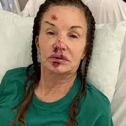 Janice Dickinson mostra fotos de queda que deixou o rosto desfigurado