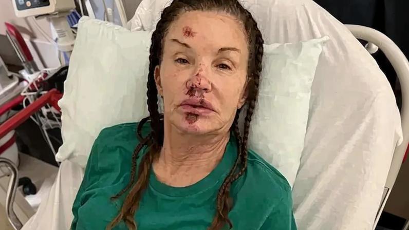 Janice Dickinson is sharing the gruesome photos from her 2022 accident.