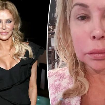 Brandi Glanville revela causa de parasita facial que a fez envelhecer 20 anos