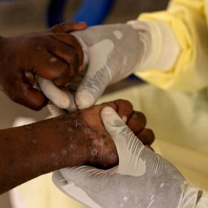Brasil registra 88 casos de Mpox em 2026 e lista formas de prevenção