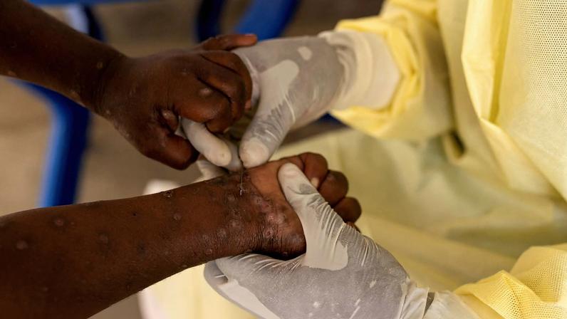 FILE PHOTO: Christian Musema, a laboratory nurse, takes a sample from a child declared a suspected case of Mpox at the treatment centre in Munigi, following Mpox cases in Nyiragongo territory near Goma, North Kivu province, Democratic Republic of the Congo July 19, 2024. Reuters/Arlette Bashizi/Proibida reprodução
