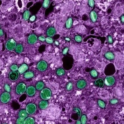 Mpox: guia rápido sobre sintomas, riscos e vacina