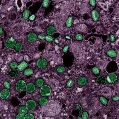 Mpox: 16 perguntas e respostas para entender a doença