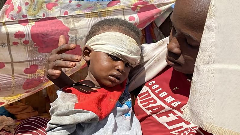 A Sudanese child, who fled El Fasher city with family after Sudan's paramilitary forces attacked the western Darfur region, receives treatment at a camp in Tawila, Sudan.