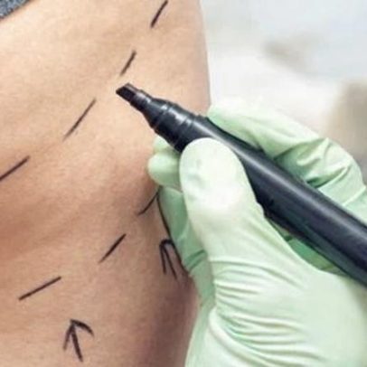 Parlamentares defendem banimento da gluteoplastia brasileira no Reino Unido