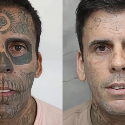 Mais tatuado do Brasil se submete a nova remoção e comenta vida missionária