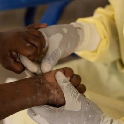 Brasil registra 88 casos de Mpox em 2026 e orienta prevenção
