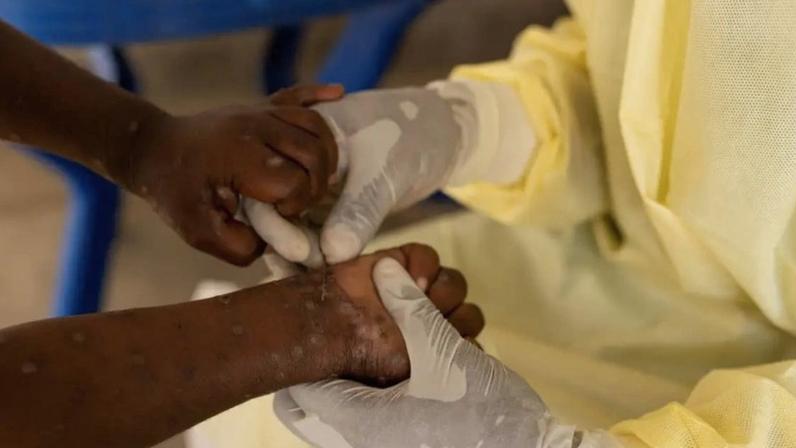 Monkeypox é transmitida por contato próximo com lesões e fluidos de pessoas infectadas
