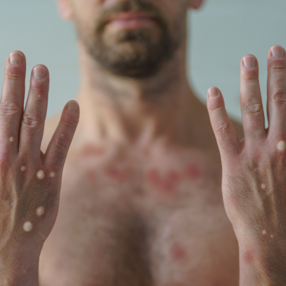Com infectados em 7 estados, Mpox atinge 81 casos no Brasil