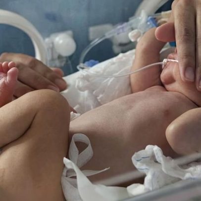 SUS amplia imunobiológico para bebês comorbidades contra bronquiolite