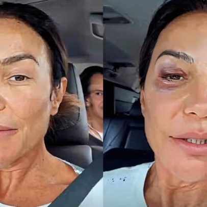 Ivete Sangalo recebe alta após queda e desmaio; médicos apontam predisposição