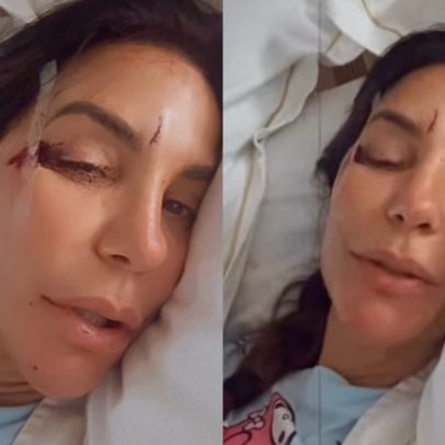 Ivete Sangalo é internada após queda que causou machucados no rosto