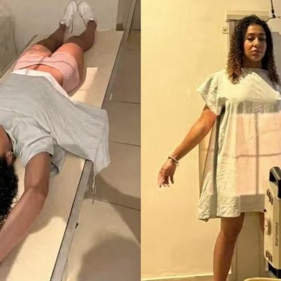 Influenciadora exibe raio-X após bolas de pompoarismo ficarem presas