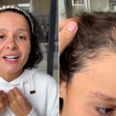 Maiara relata trauma com queda de cabelo e dificuldade de se olhar no espelho