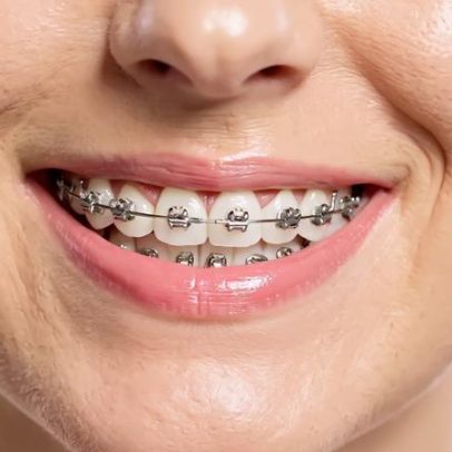 Por que os dentes voltam a entortar após o uso de aparelho ortodôntico